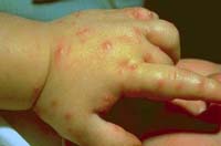 Pustules on a baby&#039;s hand from fire ant stings